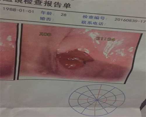排卵功能障碍_胎停的染色体异常_【在广州供卵机构靠谱吗】出现宫腔积液，不